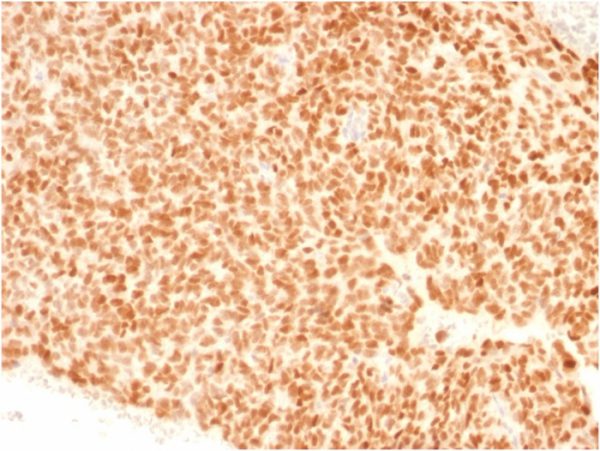 Formalin-fixed, paraffin-embedded human Ewing&apos;s Sarcoma stained with NKX2.2 Mouse Monoclonal Antibody (NX2/1523).