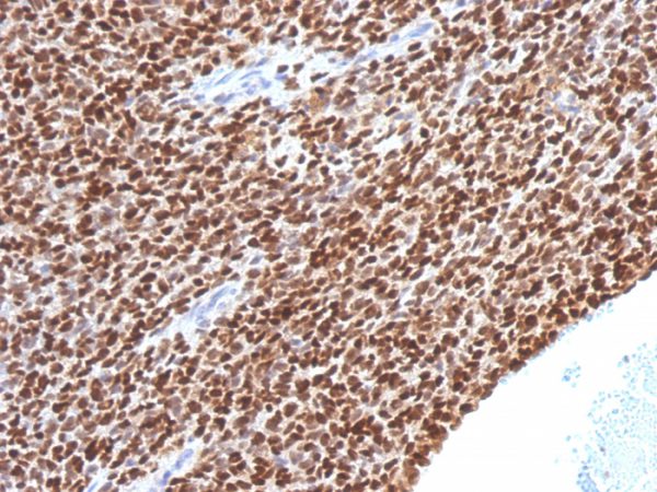 Formalin-fixed, paraffin-embedded human Ewing&apos;s Sarcoma stained with NKX2.2 Mouse Monoclonal Antibody (NX2/1524).