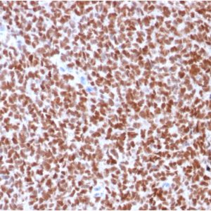 Formalin-fixed, paraffin-embedded human Ewing&apos;s Sarcoma stained with NKX2.2-Monospecific Recombinant Mouse Monoclonal Antibody (rNX2/294).