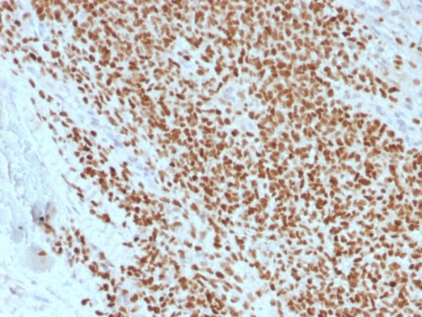 Formalin-fixed, paraffin-embedded human Ewing&apos;s Sarcoma stained with NKX2.2 Mouse Recombinant Monoclonal Antibody (rNX2/1523).