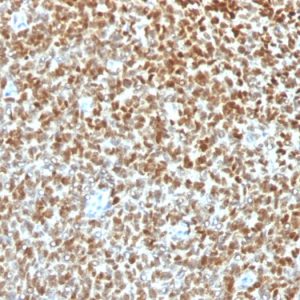 Formalin-fixed, paraffin-embedded human Ewing&apos;s Sarcoma stained with NKX2.2 Rabbit Recombinant Monoclonal Antibody (NX2/1422R).