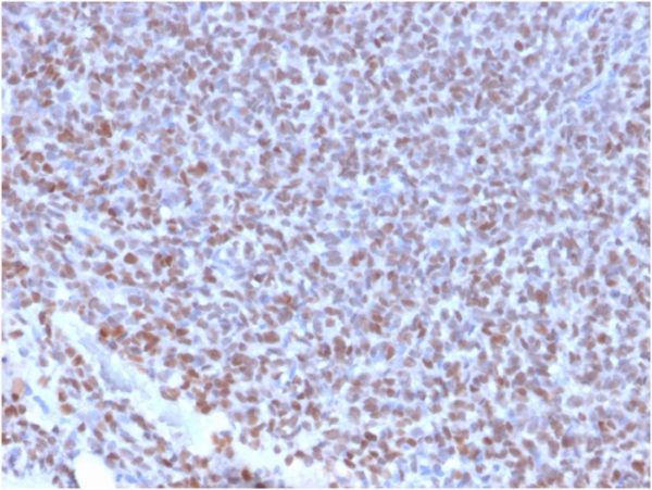 Formalin-fixed, paraffin-embedded human Ewing&apos;s Sarcoma stained with NKX2.2 Rabbit Recombinant Monoclonal Antibody (NX2/2198R).