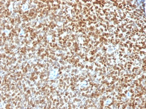 Formalin-fixed, paraffin-embedded human Ewing&apos;s Sarcoma stained with NKX2.2 Rabbit Polyclonal Antibody.