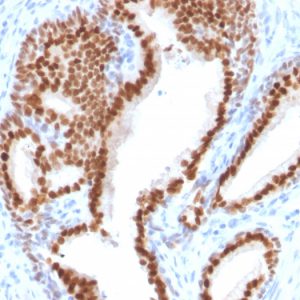 Formalin-fixed, paraffin-embedded human Prostate Carcinoma stained with NKX3.1-Monospecific Mouse Monoclonal Antibody (NKX3.1/2576).