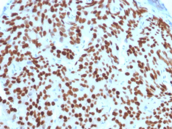 Formalin-fixed, paraffin-embedded human Prostate Carcinoma stained with NKX3.1-Monospecific Mouse Monoclonal Antibody (NKX3.1/2576).