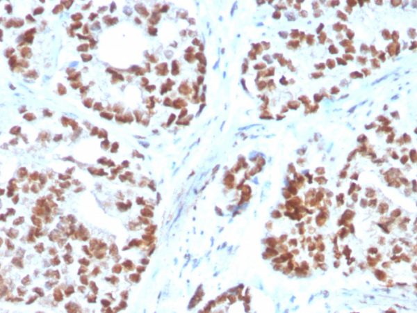 Formalin-fixed, paraffin-embedded human Prostate Carcinoma stained with NKX3.1 Mouse Monoclonal Antibody (NKX3.1/3350).