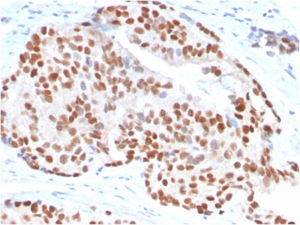Formalin-fixed, paraffin-embedded human Prostate Carcinoma stained with NKX3.1-Monospecific Mouse Monoclonal Antibody (NKX3.1/3347).