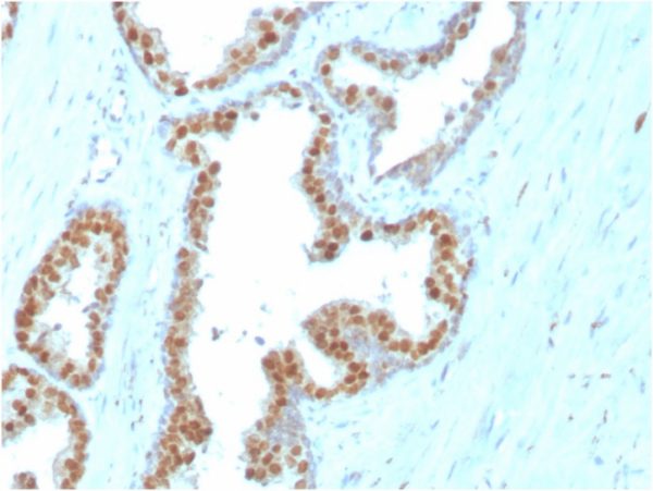 Formalin-fixed, paraffin-embedded human Prostate Carcinoma stained with NKX3.1-Monospecific Mouse Monoclonal Antibody (NKX3.1/3347).
