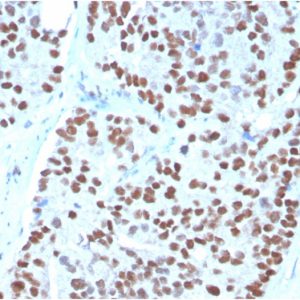 Formalin-fixed, paraffin-embedded human Prostate Carcinoma stained with NKX3.1-Monospecific Mouse Monoclonal Antibody (NKX3.1/3348).