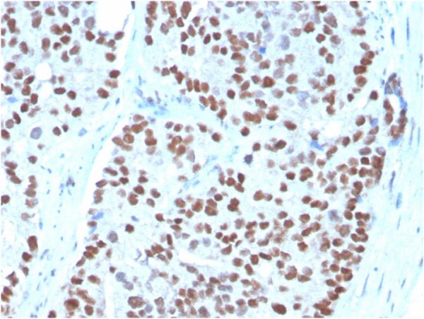 Formalin-fixed, paraffin-embedded human Prostate Carcinoma stained with NKX3.1-Monospecific Mouse Monoclonal Antibody (NKX3.1/3348).
