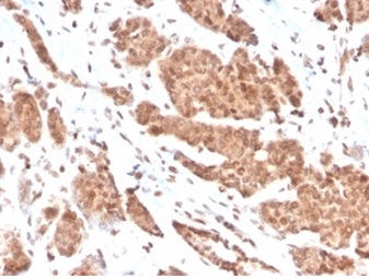 Formalin-fixed, paraffin-embedded human breast carcinoma stained with NME1 / nm23-H1 Mouse Monoclonal Antibody (NME1/2737).