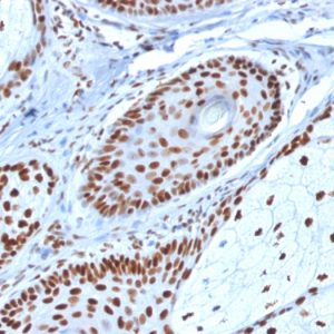Formalin-fixed, paraffin-embedded human Basal Cell Carcinoma stained with Nucleophosmin-Monospecific Mouse Monoclonal Antibody (NPM1/1902).