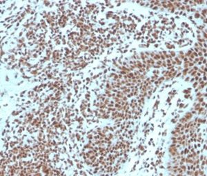 Formalin-fixed, paraffin-embedded human Basal Cell Carcinoma stained with Nucleophosmin-Monospecific Mouse Monoclonal Antibody (NPM1/3287).