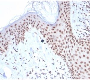 Formalin-fixed, paraffin-embedded human basal cell carcinoma stained with NucleophosminRecombinant Rabbit Monoclonal Antibody (NPM1/7072R). HIER: Tris/EDTA, pH9.0, 45min. 2°C: HRP-polymer, 30min. DAB, 5min.