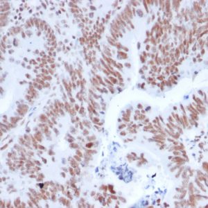 Formalin-fixed, paraffin-embedded human Colon Carcinoma stained with NRF1 Mouse Monoclonal Antibody (NRF1/2608).