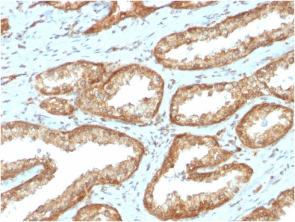 Formalin-fixed, paraffin-embedded human Prostate Carcinoma stained with YBX1 Mouse Monoclonal Antibody (YBX1/2430)