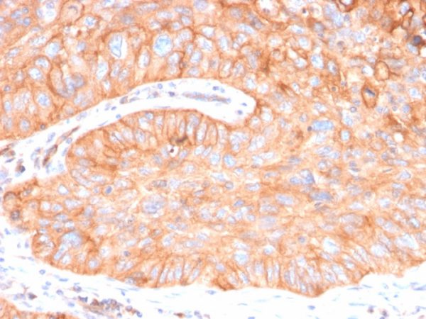 Formalin-fixed, paraffin-embedded human Colon Carcinoma stained with CD73 Mouse Monoclonal Antibody (NT5E/2646).