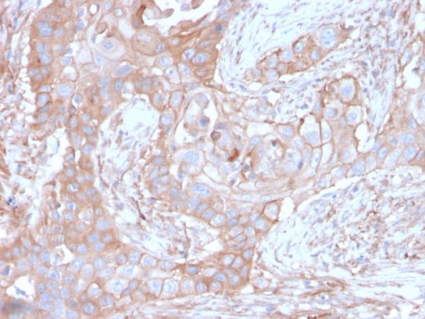Formalin-fixed, paraffin-embedded human Colon Carcinoma stained with CD73 Mouse Monoclonal Antibody (NT5E/2646).
