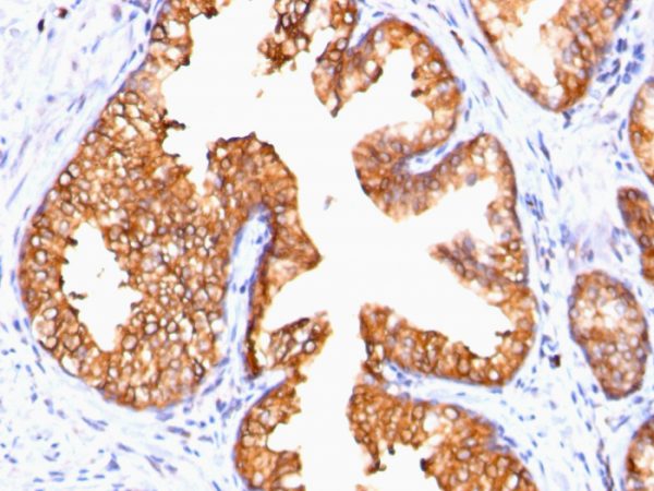 Formalin-fixed, paraffin-embedded human Prostate Carcinoma stained with ODC-1 Mouse Monoclonal Antibody (ODC1/485).