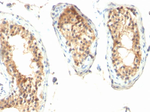 Formalin-fixed, paraffin-embedded human Testicular Carcinoma stained with ODC-1 Mouse Monoclonal Antibody (ODC1/485).