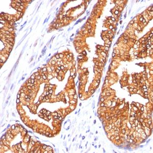 Formalin-fixed, paraffin-embedded human Prostate Carcinoma stained with ODC-1 Monoclonal Antibody (SPM565)
