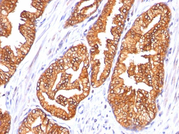Formalin-fixed, paraffin-embedded human Prostate Carcinoma stained with ODC-1 Monoclonal Antibody (SPM565)