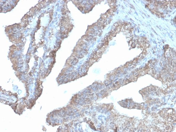 Formalin-fixed, paraffin-embedded human prostate carcinoma stained with ODC-1 Recombinant Mouse Monoclonal Antibody (rODC1/485).