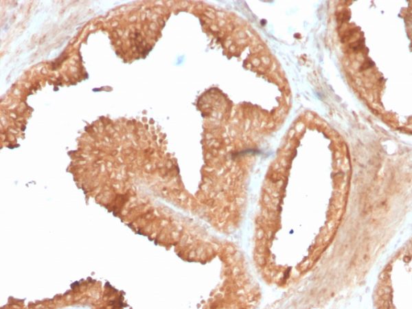 Formalin-fixed, paraffin-embedded human prostate carcinoma stained with ODC-1 Recombinant Rabbit Monoclonal Antibody (ODC1/3636R).
