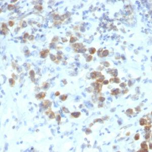 Formalin-fixed, paraffin-embedded human Gastric Carcinoma stained with PAX6 Monoclonal Antibody (SPM612).