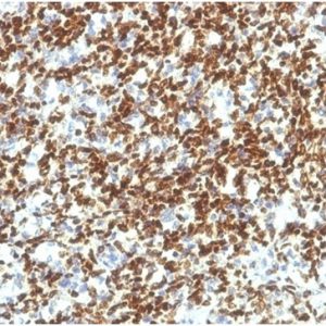 Formalin-fixed, paraffin-embeddedhuman rhabdomyosarcoma stained with PAX7 Mouse Monoclonal Antibody(PAX7/1187).
