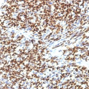 Formalin-fixed, paraffin-embedded human Rhabdomyosarcoma stained with PAX7 Monoclonal Antibody (SPM613).