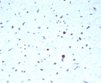Formalin-fixed, paraffin-embedded human rhabdomyosarcoma stained with PAX7 Recombinant Rabbit Monoclonal Antibody (PAX7/7079R). HIER: Tris/EDTA, pH9.0, 45min. 2 °: HRP-polymer, 30min. DAB, 5min.