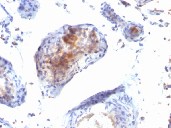 Formalin-fixed, paraffin-embedded human testicular carcinoma stained with FOXP3 Mouse Monoclonal Antibody (FXP3/197).