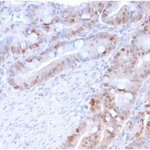 Formalin-fixed, paraffin-embedded human colon carcinoma stained with PCNA Mouse Monoclonal Antibody (PC5).