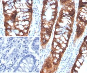 Formalin-fixed, paraffin-embedded human colon stained with PDGF beta Mouse Monoclonal Antibody (PDGFB/3072). Inset: PBS instead of primary antibody, secondary antibody negative control.