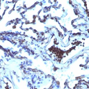 Formalin-fixed, paraffin-embedded human Lung Carcinoma stained with TDP2 Mouse Monoclonal Antibody (TDP2/1258)