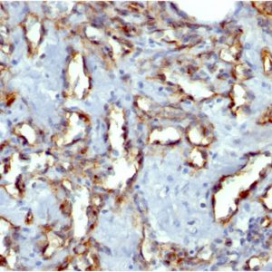 Formalin-fixed, paraffin-embedded human Angiosarcoma stained with CD31 Mouse Monoclonal Antibody (C31.7).