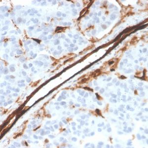 Formalin-fixed, paraffin-embedded human tumor of unknown origin stained with CD31 Mouse Monoclonal Antibody (PECAM1/3526).