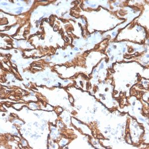 Formalin-fixed, paraffin-embedded human angiosarcoma stained with CD31 Mouse Monoclonal Antibody (PECAM1/3529).