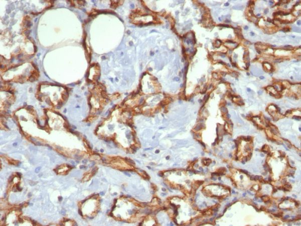 Formalin-fixed, paraffin-embedded human Angiosarcoma stained with CD31 Mouse Monoclonal Antibody (C31.3).