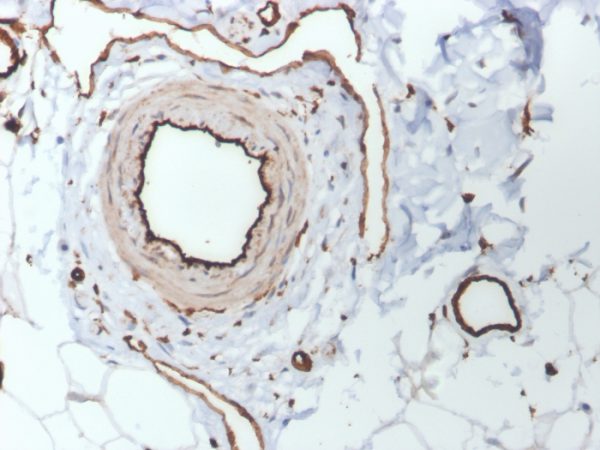 Formalin-fixed, paraffin-embedded human skin stained with CD31 Mouse Monoclonal Antibody (PECAM1/3530).