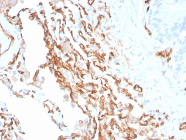 Formalin-fixed, paraffin-embedded human Colon stained with CD31 Mouse Monoclonal Antibody (PECAM1/3534).