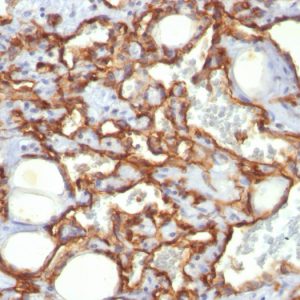 Formalin-fixed, paraffin-embedded human Angiosarcoma stained with CD31 Monoclonal Antibody (SPM532)