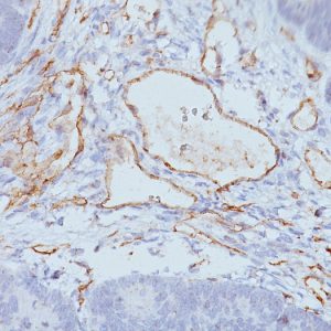 Formalin-fixed, paraffin-embedded human Colon Carcinoma stained with CD31 Monoclonal Antibody (C31.3 + JC/70A)