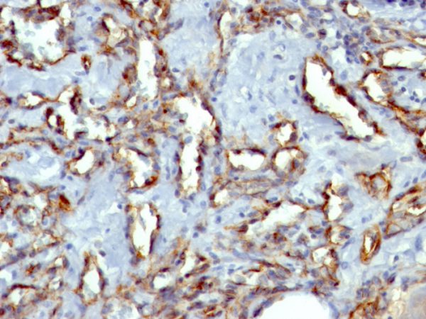 Formalin-fixed, paraffin-embedded human Angiosarcoma stained with CD31 Monoclonal Antibody (C31.3 + JC/70A)