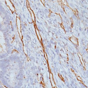 Formalin-fixed, paraffin-embedded human Colon Carcinoma stained with CD31 Mouse Monoclonal Antibody (JC/70A)