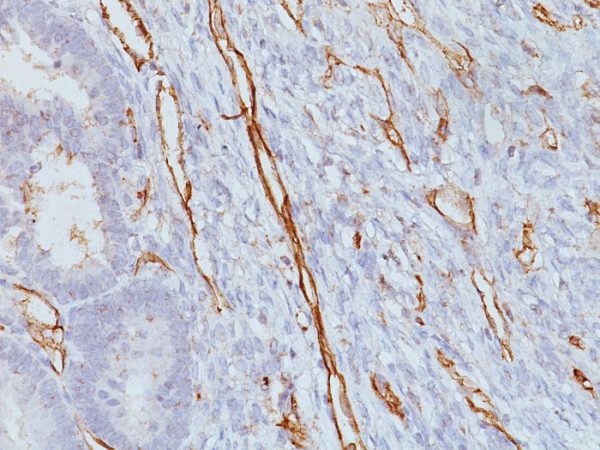 Formalin-fixed, paraffin-embedded human Colon Carcinoma stained with CD31 Mouse Monoclonal Antibody (JC/70A)