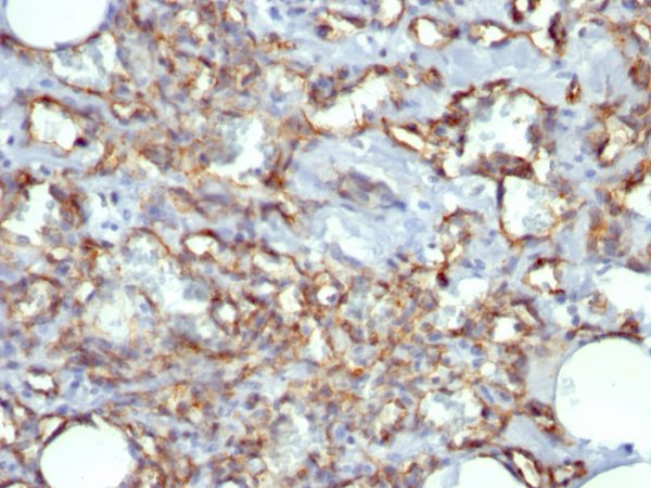 Formalin-fixed, paraffin-embedded human Angiosarcoma stained with CD31 Mouse Monoclonal Antibody (JC/70A)