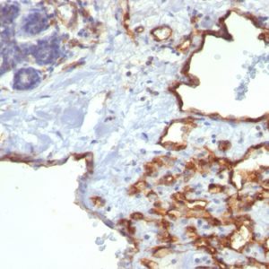 Formalin-fixed, paraffin-embedded human Angiosarcoma stained with CD31 Monoclonal Antibody (SPM122)