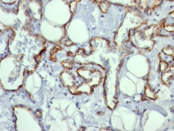 Formalin-fixed, paraffin-embedded human Angiosarcoma stained with CD31 Mouse Monoclonal Antibody (C31.10).